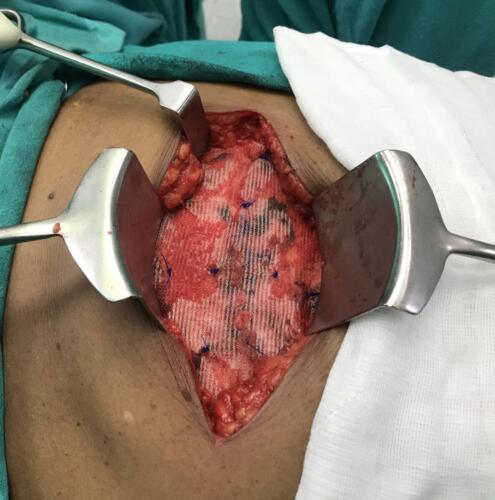 Hernia repair