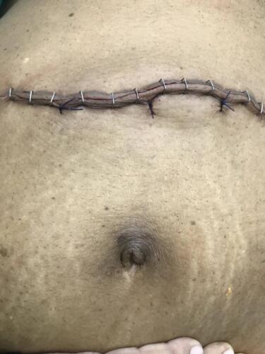 Hernia