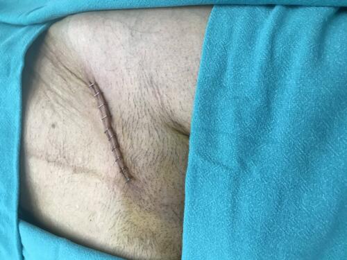 Scar