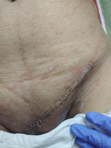 Scar