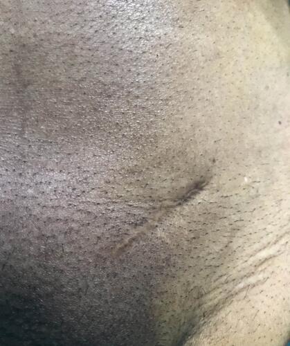 Scar