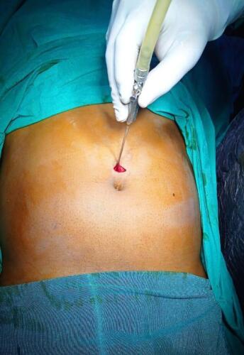 How we start laparoscopy.