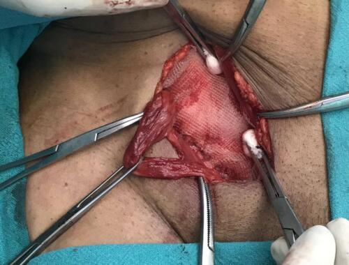 Hernia