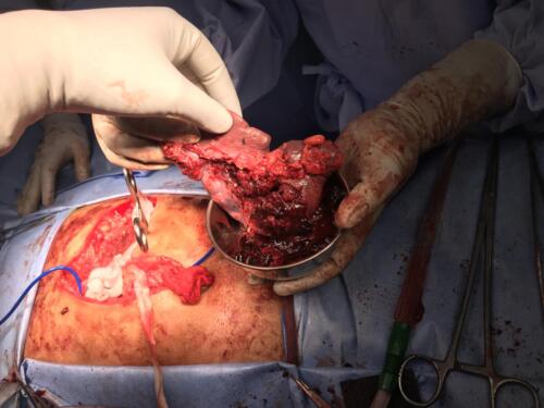 Spleen