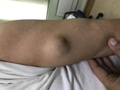 Cyst
