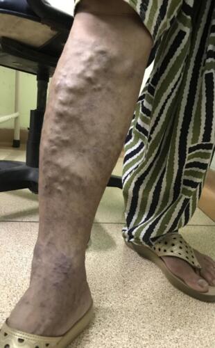 Varicose veins