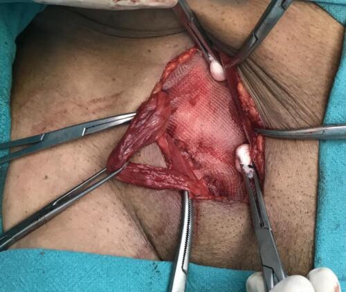 Hernia