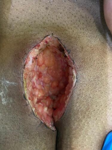 Wound