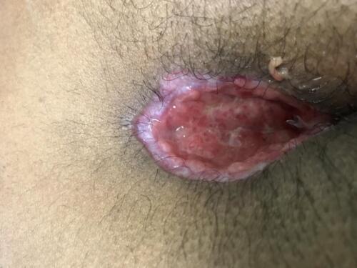 Wound