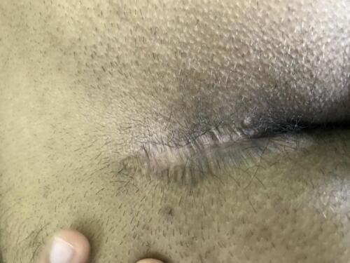 Scar