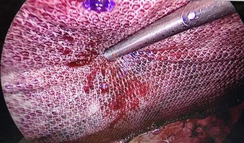 Hernia