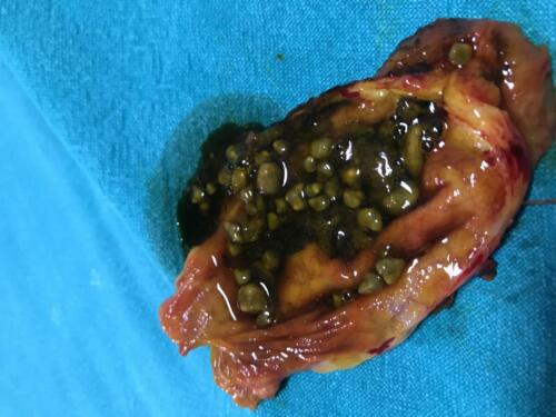 Gallstones