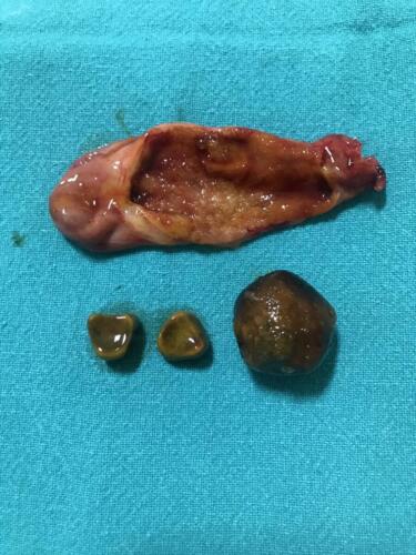 Removed specimens