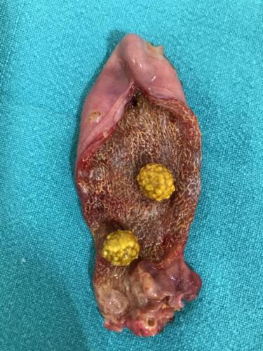 Gallstones