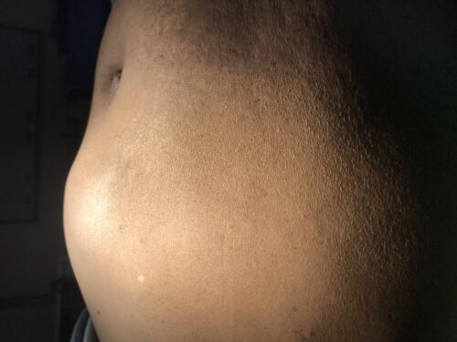 hernia