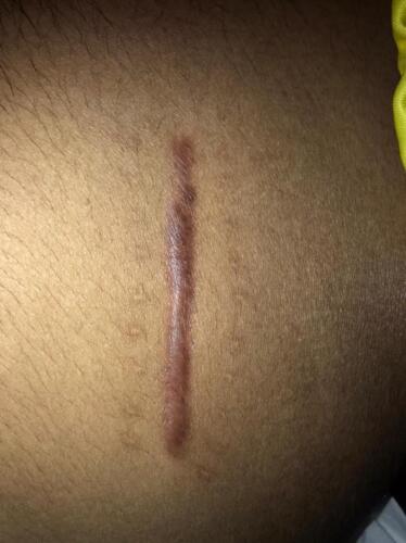 Scar