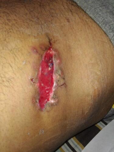 wound