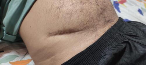 Scar