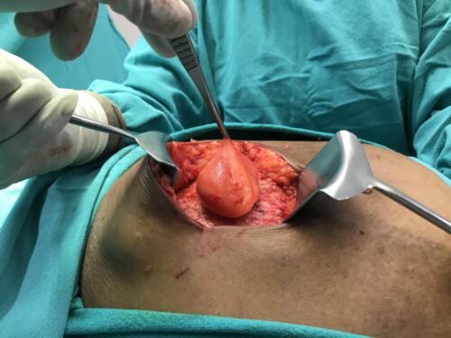 Hernia
