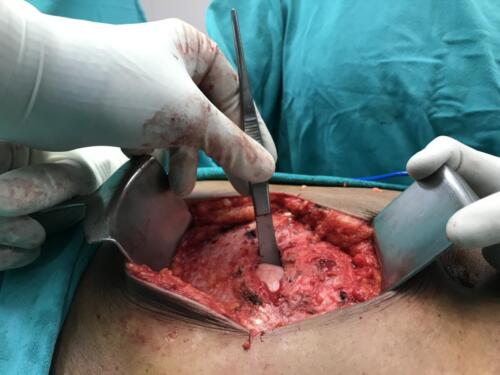 Hernia