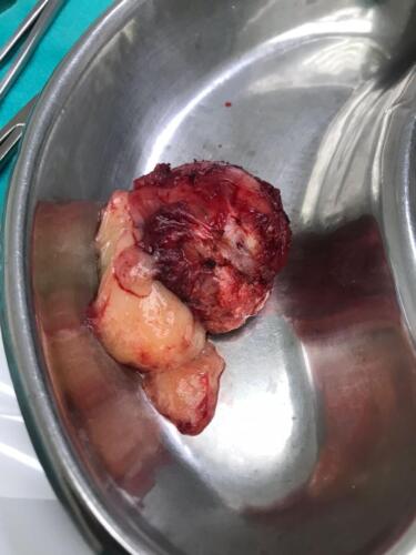 Tumour