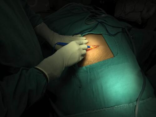 Cautery