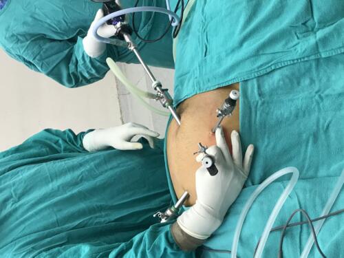 Laparoscopy