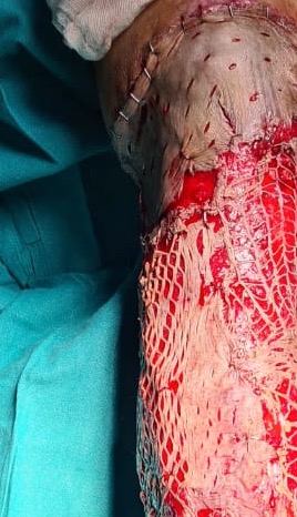 large area of skin grafting