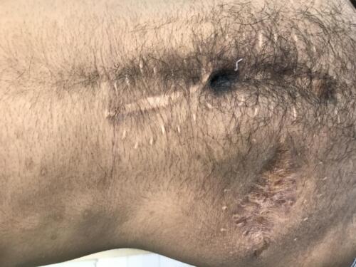 Scar 