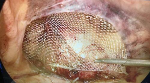 Hernia