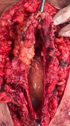 Hernia